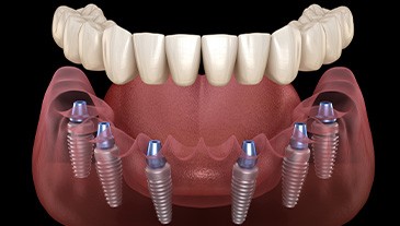 Digital illustration of an implant denture