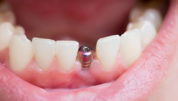 patient smiling with titanium post in mouth